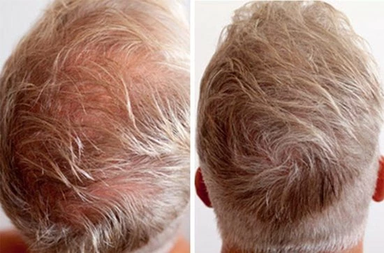 Beste deal π IMPERIO Premium Haarvezels Donkerbruin - Kaalheid Mannen - Alopecia Vrouwen - 100% Onzichtbaar π 20 Beste deal π IMPERIO Premium Haarvezels Donkerbruin - Kaalheid Mannen - Alopecia Vrouwen - 100% Onzichtbaar π - Afbeelding 18