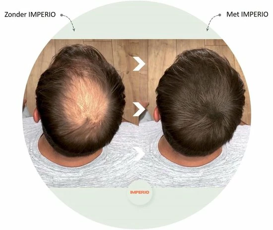 Beste deal π IMPERIO Premium Haarvezels Donkerbruin - Kaalheid Mannen - Alopecia Vrouwen - 100% Onzichtbaar π 11 Beste deal π IMPERIO Premium Haarvezels Donkerbruin - Kaalheid Mannen - Alopecia Vrouwen - 100% Onzichtbaar π - Afbeelding 9