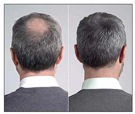 Beste deal π IMPERIO Premium Haarvezels Donkerbruin - Kaalheid Mannen - Alopecia Vrouwen - 100% Onzichtbaar π 14 Beste deal π IMPERIO Premium Haarvezels Donkerbruin - Kaalheid Mannen - Alopecia Vrouwen - 100% Onzichtbaar π - Afbeelding 12