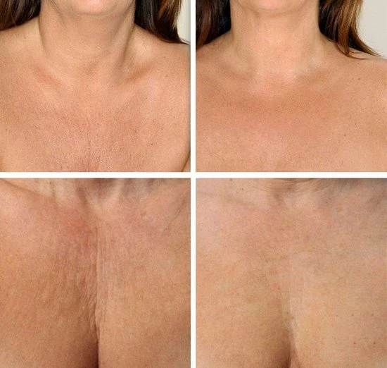 Beste Pirce π Simia™ Anti Rimpel Beauty Pads - Decolleté Large T Shape Set (2 Stuks) - Herbruikbaar Anti Aging Siliconen Pad Tegen Lijntjes En Slaaprimpels π 6 Beste Pirce π Simia™ Anti Rimpel Beauty Pads - Decolleté Large T Shape Set (2 Stuks) - Herbruikbaar Anti Aging Siliconen Pad Tegen Lijntjes En Slaaprimpels π - Afbeelding 4