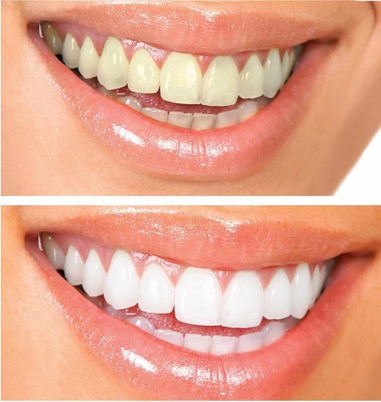 Gloednieuw π Tandenbleekset - Inclusief Teeth Whitening Strips + Wipes + 3 Gelspuiten - Zonder Peroxide 100% Natuurlijk - Dierproefvrij - Wittere Tanden - 3D LED - Teeth Whitening - Premium Edition Statch π₯ 8 Gloednieuw π Tandenbleekset - Inclusief Teeth Whitening Strips + Wipes + 3 Gelspuiten - Zonder Peroxide 100% Natuurlijk - Dierproefvrij - Wittere Tanden - 3D LED - Teeth Whitening - Premium Edition Statch π₯ - Afbeelding 6